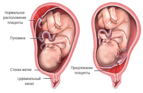 осложнения беременности Предлежание плаценты