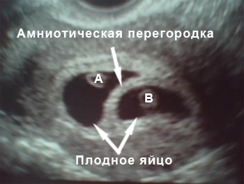 Фото УЗИ 7 неделя беременности двойня