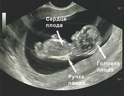 Фото УЗИ 11 неделя беременности