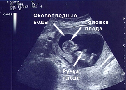 Фото УЗИ 12 неделя беременности
