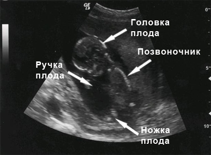 Фото УЗИ 14 неделя беременности