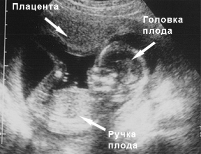 Фото УЗИ 15 неделя беременности