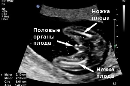 Фото УЗИ 4 неделя беременности пол ребенка