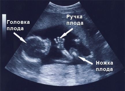 Фото УЗИ 17 неделя беременности