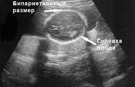 Фото УЗИ 18 неделя беременности размер головки