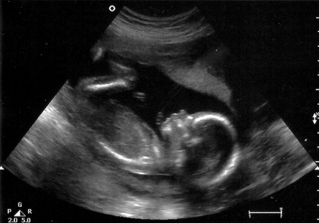 Фото УЗИ 19 неделя беременности