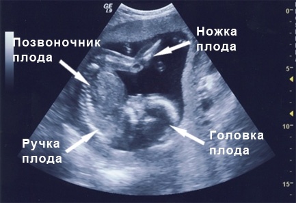 Фото узи развитие ребенка по месяцам
