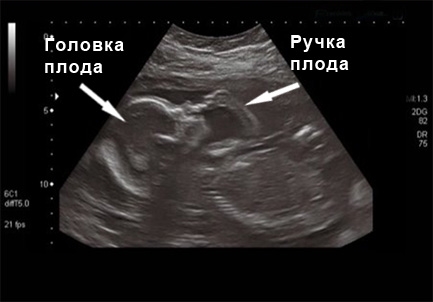 2 месяца беременности фото плода узи