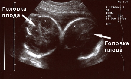 Фото УЗИ 24 неделя беременности двойня