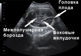 Фото УЗИ 26 неделя беременности мозг