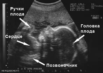 Фото узи беременности по неделям с описанием и фото