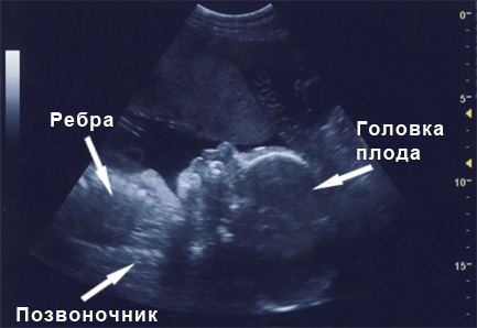 Фото УЗИ 29 неделя беременности
