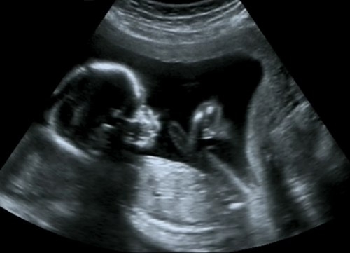 Фото УЗИ 34 неделя беременности