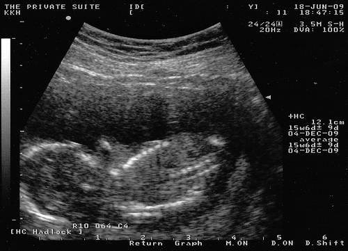 Фото УЗИ 39 неделя беременности