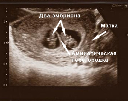 фото УЗИ на 8 неделе беременности