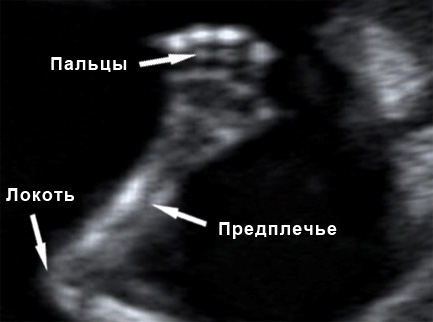 Фото УЗИ на 14 неделе беременности