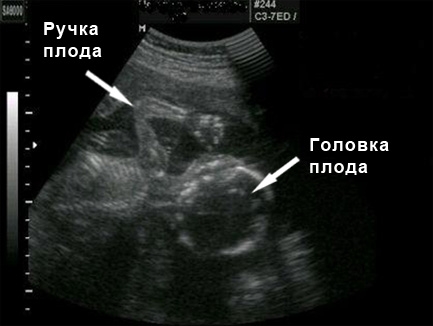 Фото УЗИ на 19 неделе беременности