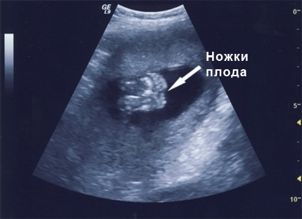 Фото УЗИ на 19 неделе беременности