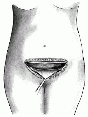 Кесарево сечение: ход операции в нижнем сегменте матки