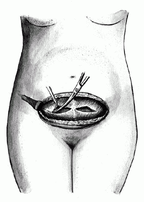 Кесарево сечение: ход операции в нижнем сегменте матки