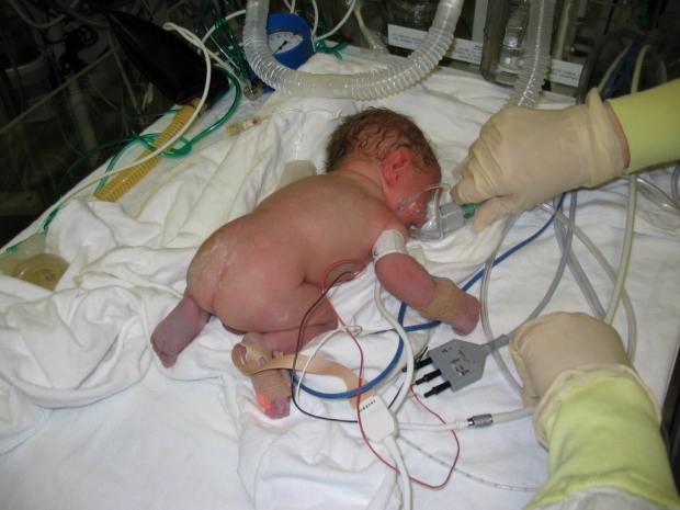 Осложнения и последствия преждевременных родов для ребенка
