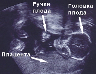 фото УЗИ на 20 неделе беременности