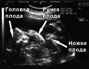 Фото УЗИ на 21 неделе беременности