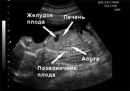 Фото УЗИ на 23 неделе беременности