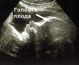 Фото УЗИ на 31 неделе беременности