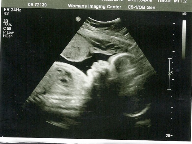 Фото УЗИ на 34 неделе беременности