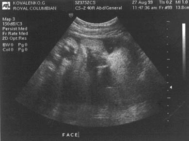 Фото УЗИ на 42 неделе беременности