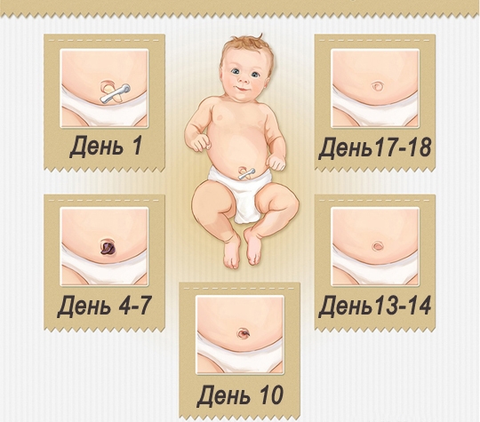Обработка пупка новорожденного