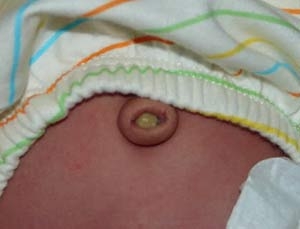 Воспаление пупка у новорожденных: фото