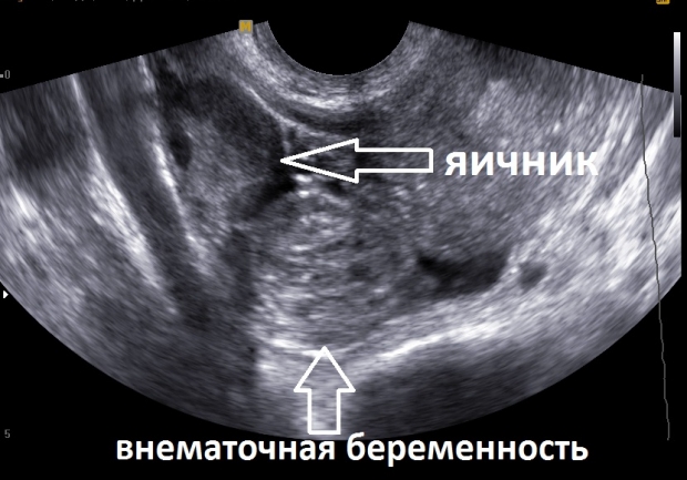 Внематочная беременность УЗИ