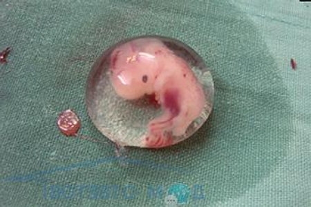 аборт на раннем сроке
