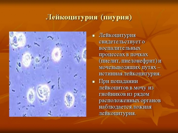 Лейкоциты в моче сильно. Появление лейкоцитов в моче. Причины повышения лейкоцитов в моче. Как называется большое количество лейкоцитов в моче. Лейкоциты (микроскопия) 2.