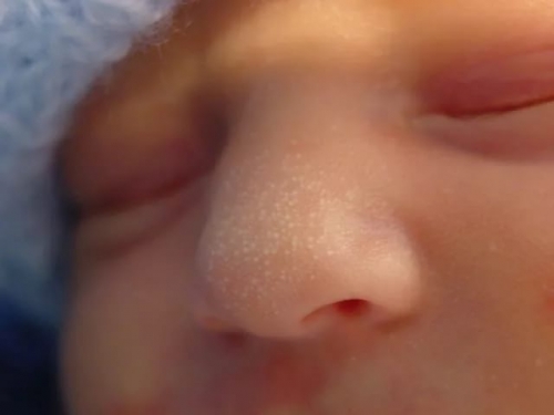 Цвет кожи на лице у новорожденного