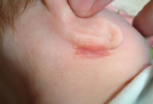У новорожденного сыпь на мочках ушей
