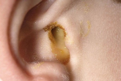 Сыпь у грудничков корочки на ушах